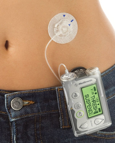 Other Insulin Pumps | Medtronic Diabetes