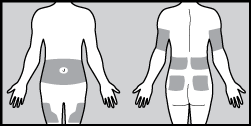 medtronic sensor placement for diabetes